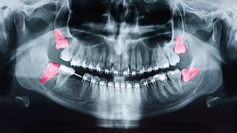 AdobeStock 223913289 1 Oral Surgery by Oral Surgery Associates of Grand Rapids