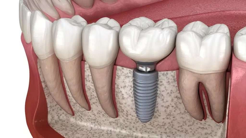 June01 blog featured image oral surgery associates Oral Surgery by Oral Surgery Associates of Grand Rapids