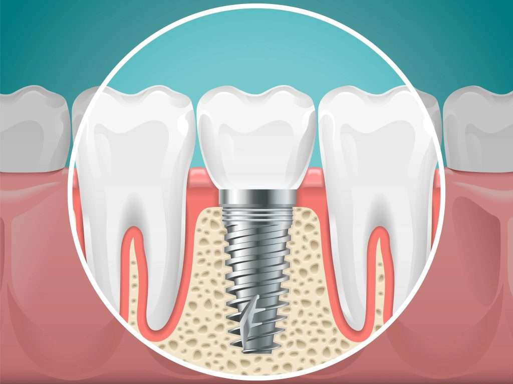 June02 blog featured image oral surgery associates Oral Surgery by Oral Surgery Associates of Grand Rapids