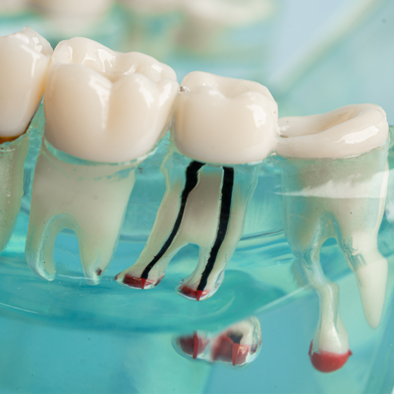 Wisdom Teeth Removal