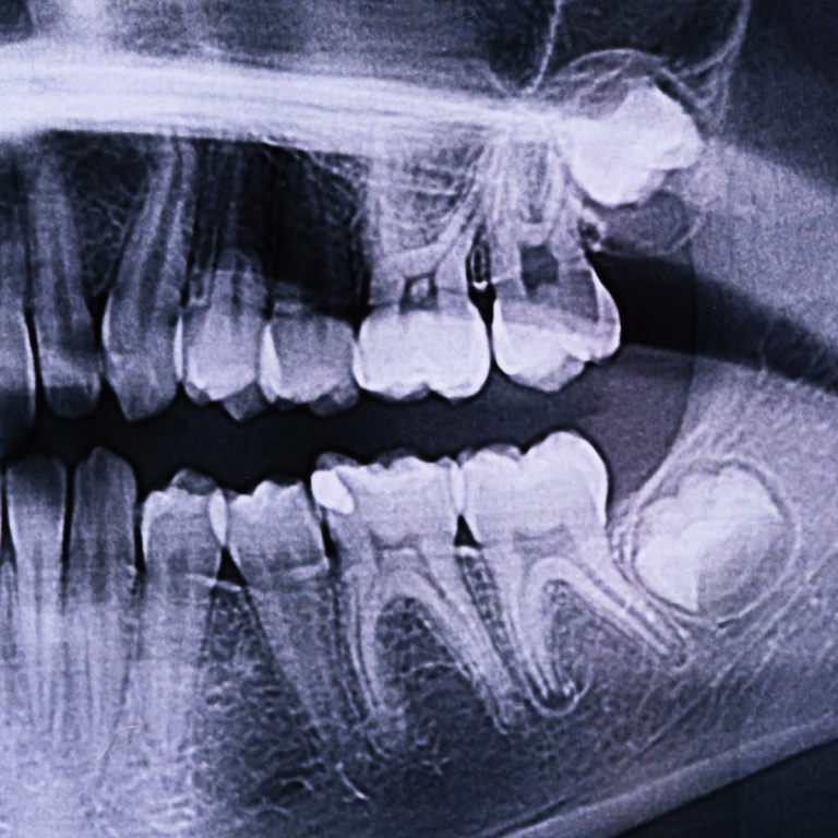 Wisdom Teeth Removal
