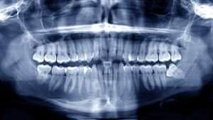 A panoramic dental X-ray showing full dental arches, jaw structure, and impacted wisdom teeth, illustrating the scope of oral and maxillofacial surgery.