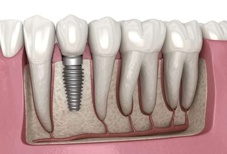 april01 blog featured image oral surgery associates Oral Surgery by Oral Surgery Associates of Grand Rapids
