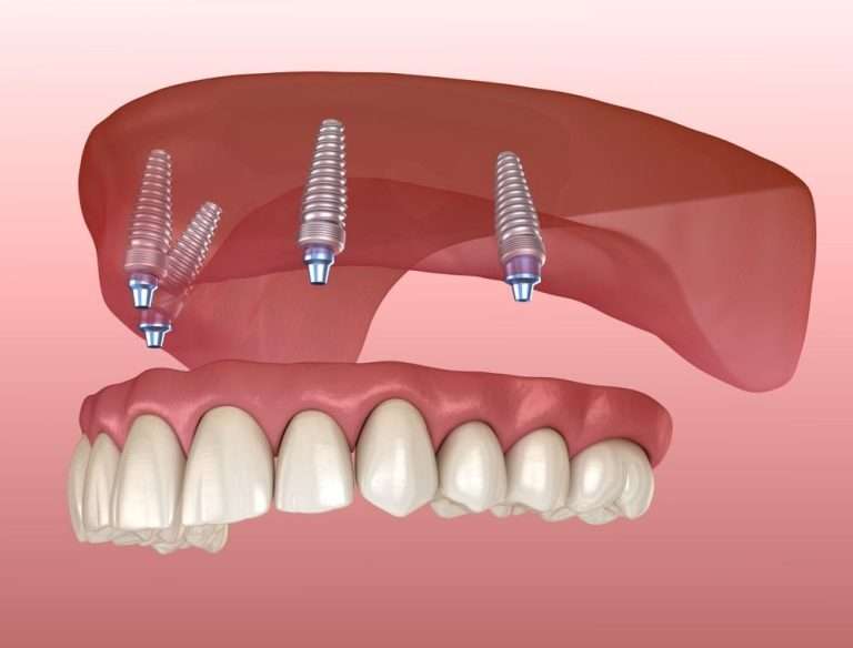 april02 blog featured image oral surgery associates Oral Surgery by Oral Surgery Associates of Grand Rapids