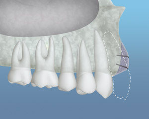 Graft Material Placed