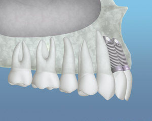 Implants Placed