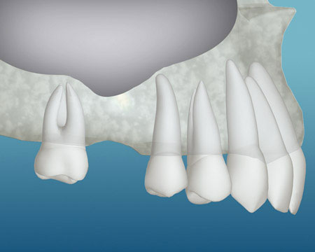 Inadequate Bone