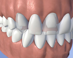 Fixed Bridge​ Replacing Missing Teeth