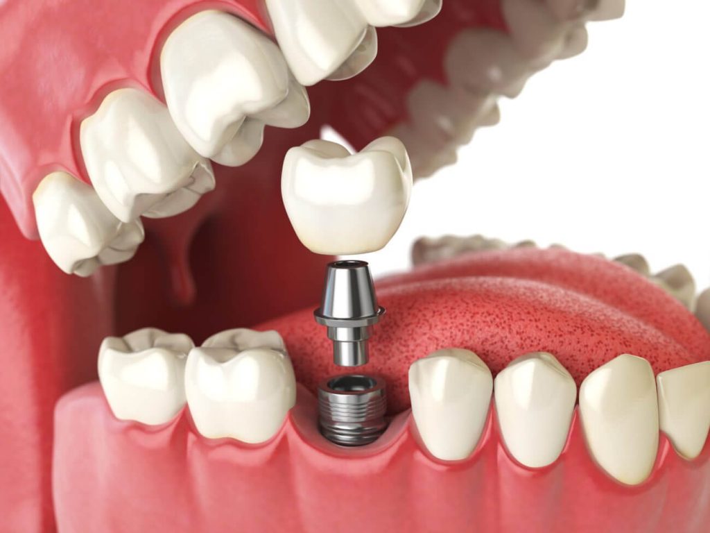 The Comprehensive Guide to Dental Implants: Restoring Your Smile and Confidence Oral Surgery Associates of Grand Rapids december blog featured image Oral Surgery by Oral Surgery Associates of Grand Rapids