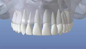 Normal Tooth