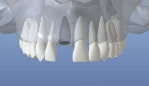 Tooth Loss