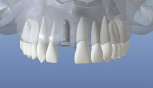 Implant Placed