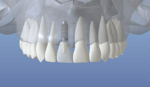 Implant Restored