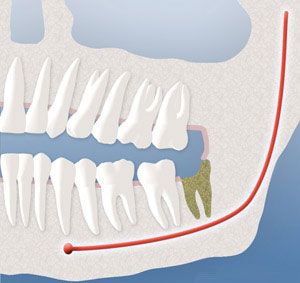 drysocket Oral Surgery by Oral Surgery Associates of Grand Rapids