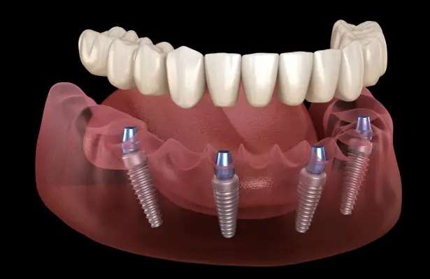 feb blog featured image oral surgery associates Oral Surgery by Oral Surgery Associates of Grand Rapids
