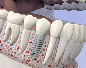 Replacing Missing Teeth