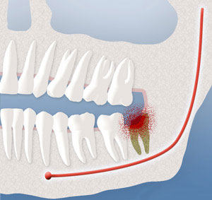 infection Oral Surgery by Oral Surgery Associates of Grand Rapids