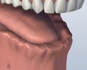 Before Implant