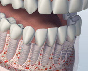 Individual Implants Placed