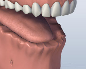 Before Bar Denture