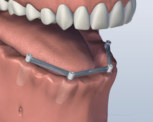 Bar Implants Placed