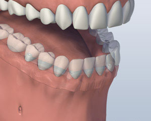 Bar Denture Attached