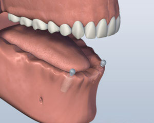 Lower Implants Placed