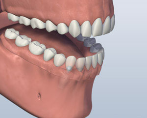 Lower Denture Attached
