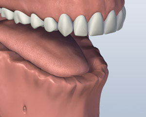 Before Screw Denture