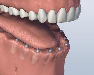 Screw Implants Placed