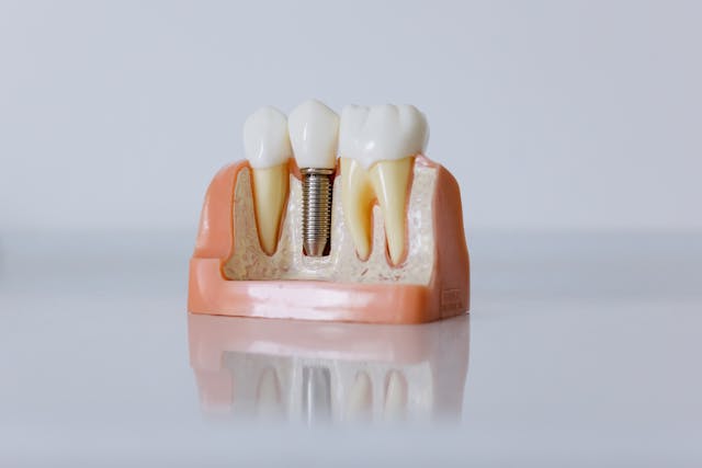 Example of Dental Implant Tooth
