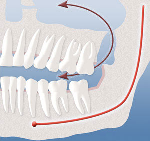 sinuscommunication Oral Surgery by Oral Surgery Associates of Grand Rapids