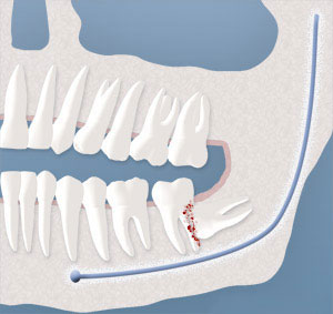 Damage to Adjacent Teeth
