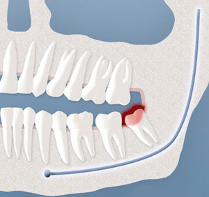 Infection In Tooth