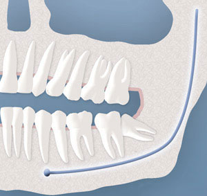 Partial Bony